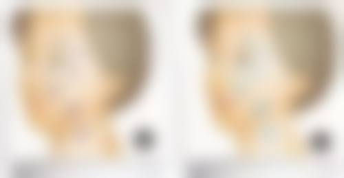 毛发种植可以再生头发吗？视频与图片来解惑