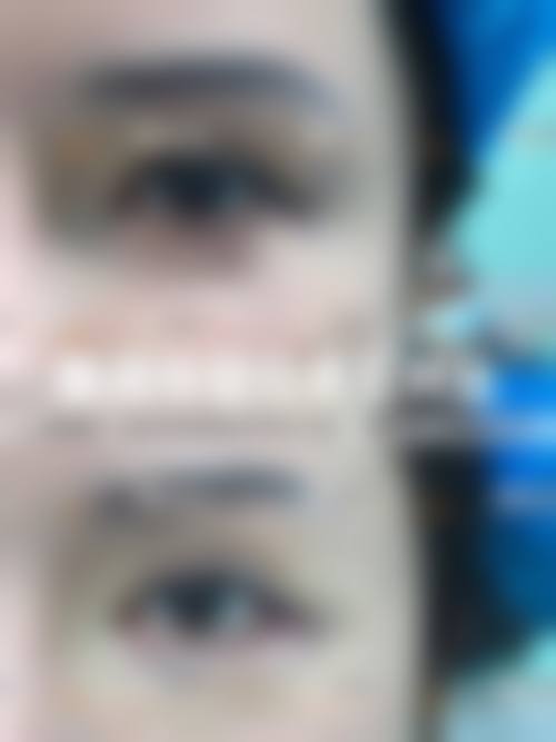 患者C：“因为脱发重度，我选择了南京大麦微针植发医院进行毛发移植。手术前医生给我做了详细的毛囊检测和方案设计，手术过程特别顺利。现在头发长得越来越好，整个人都自信了特别多，真的感谢这家医院。”