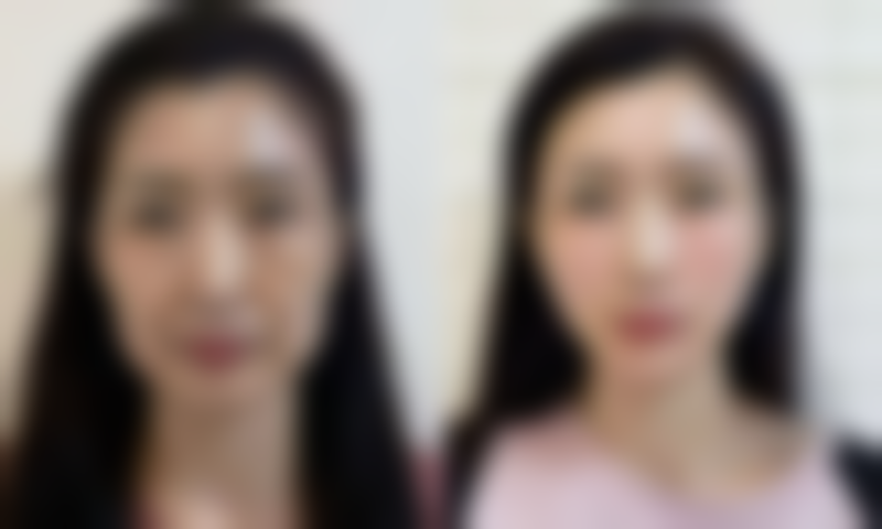 鼻梁歪能做隆鼻吗