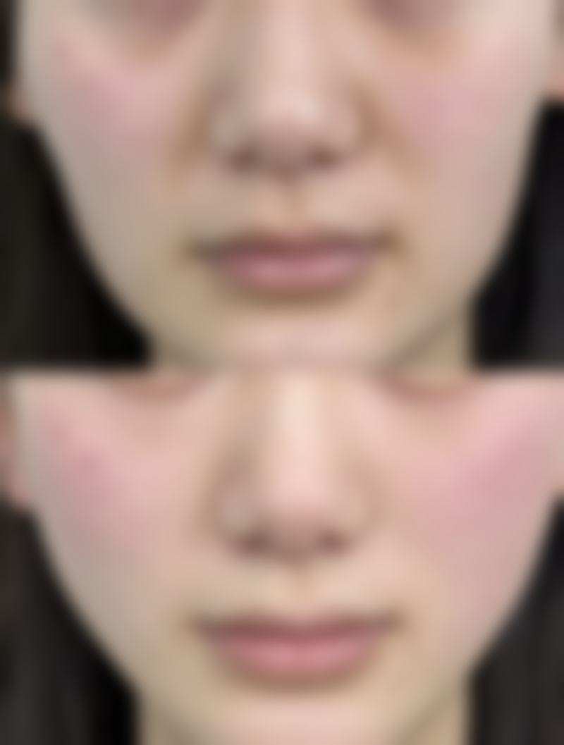 打除皱针有什么副作用