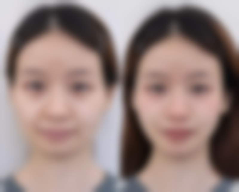 瘦脸针剂量的安心范围