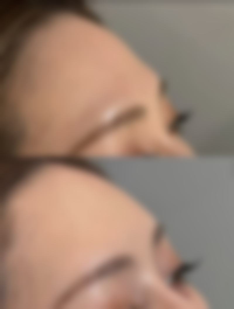 毛发种植成功几率高吗？多方面因素来分析