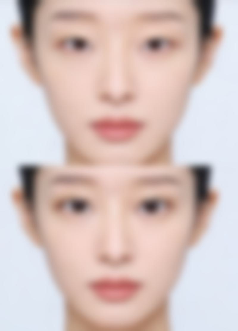 鼻梁歪了做手术有风险吗