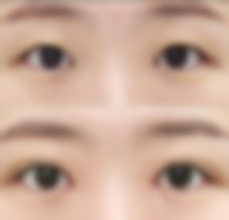 50岁可以打肉毒素吗？