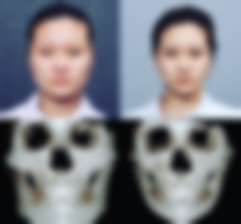 打除皱针停了会更老吗