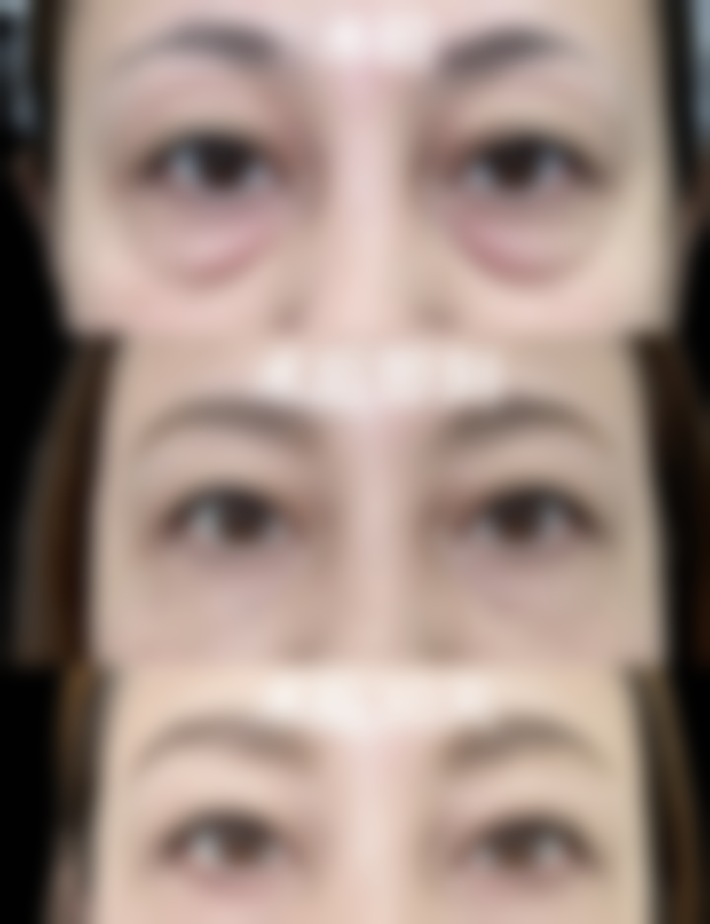 打除皱针打成了肿眼泡