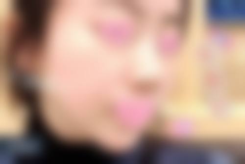 国产瘦脸针的成效