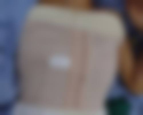 玻尿酸丰太阳穴的成效如何？