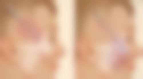 打除皱针除皱效果怎么样？揭秘数据说话：85%体验者反馈效果显著，让肌肤年轻5-10岁不是梦！ 