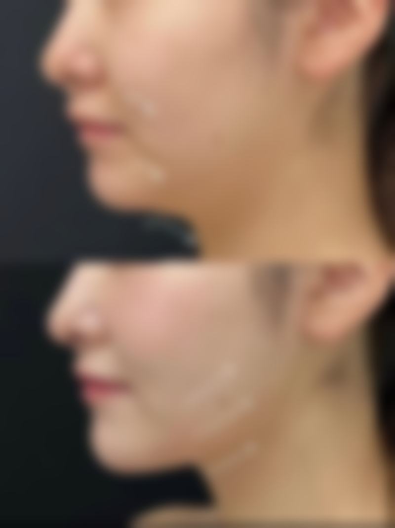 小微脸瘦脸针多少钱？