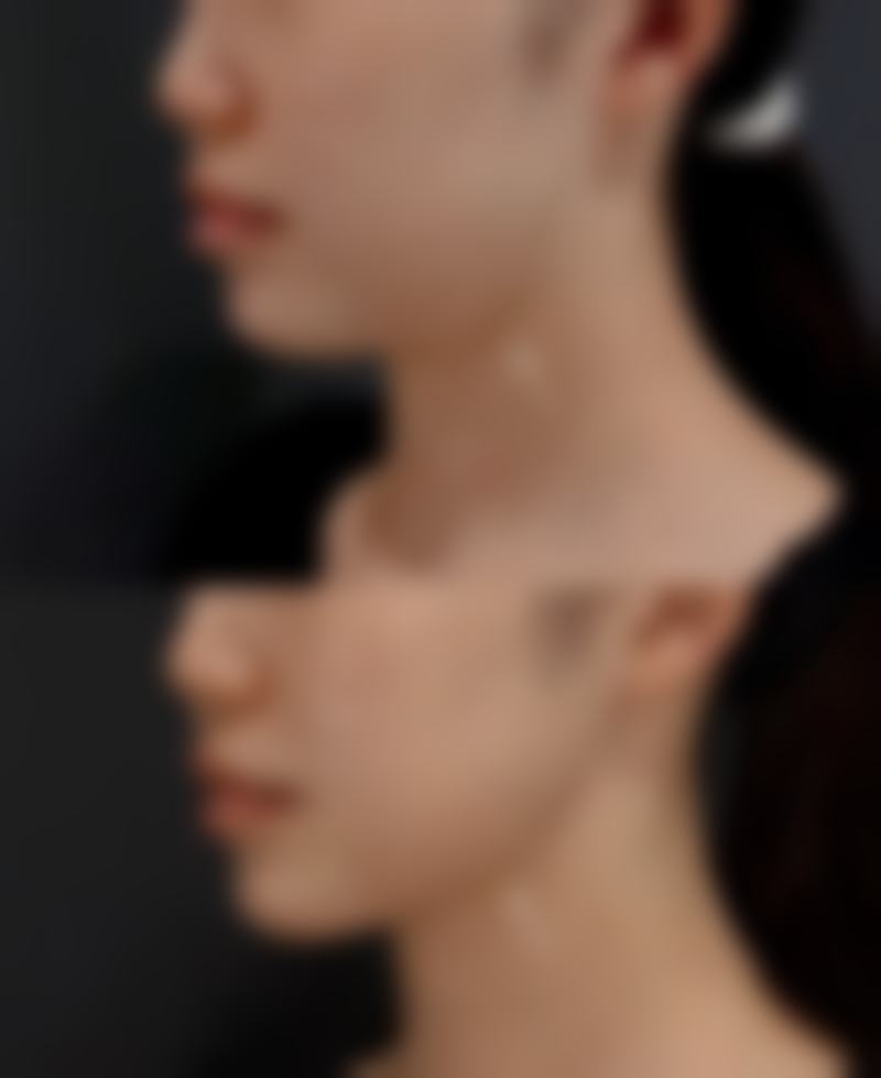 阴道紧缩后注意事项