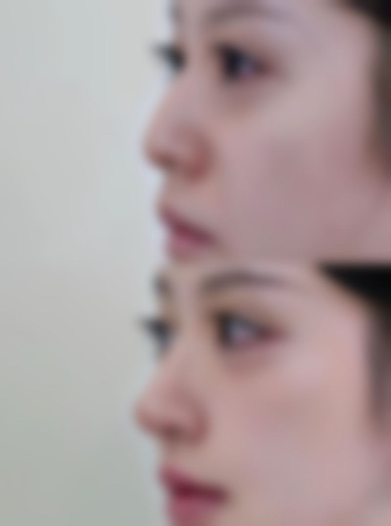 打瘦脸针算整容吗