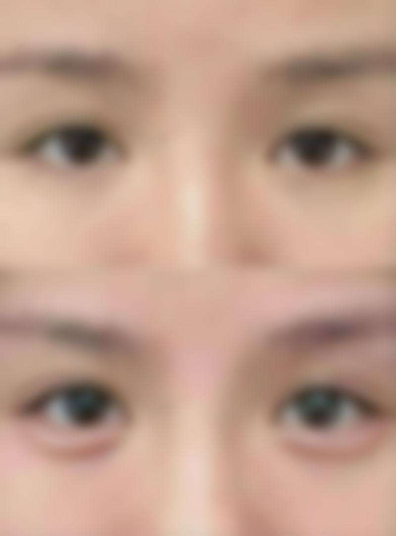 瘦脸针能维持多久