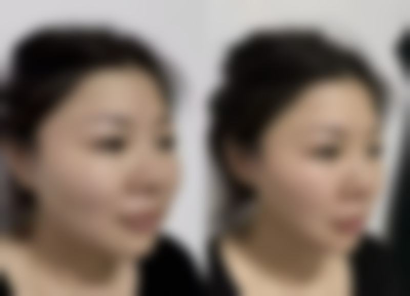 做小微脸有什么副作用？