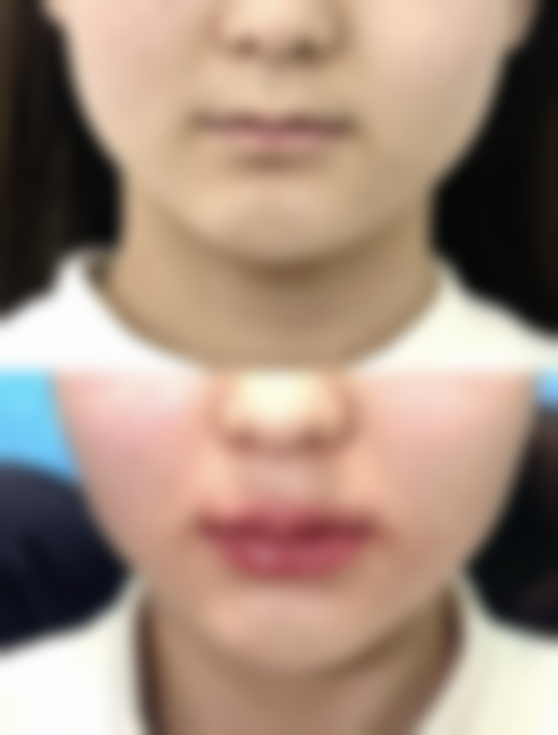 瘦脸针一般能坚持多久？揭秘3 - 6个月效果维持期，掌握延长瘦脸时效秘诀让小脸持久在线！ 