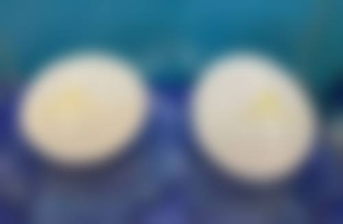 自体脂肪丰臀有用吗?成效看得见