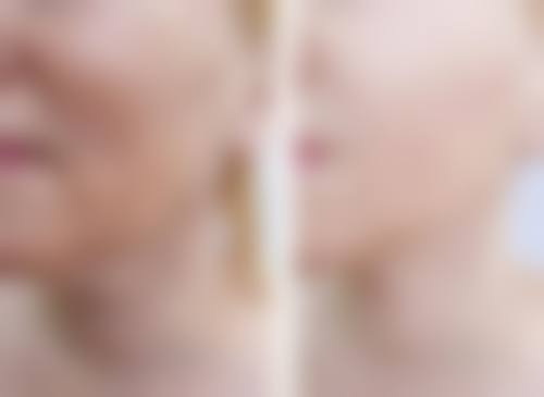 自体脂肪丰臀成效好吗?会吸收吗?