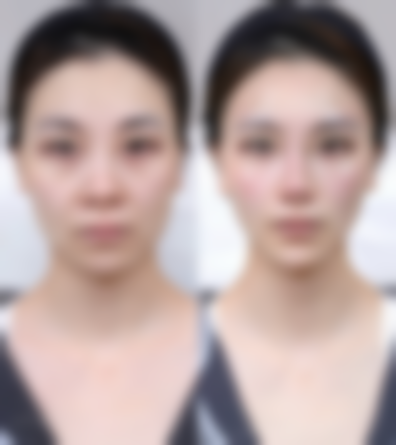 那么,植发的至佳时机是什么时候呢?