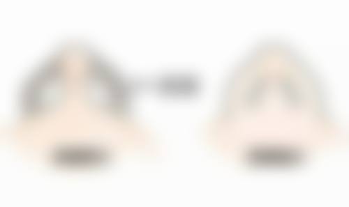 脸部除皱多久见效