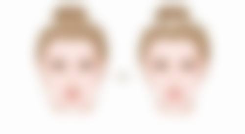 发际线种植的真实经历