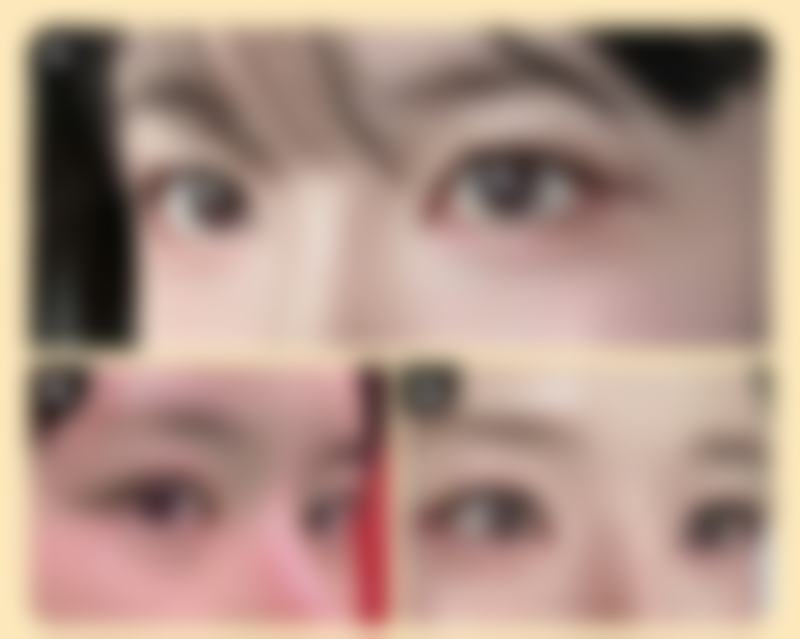 发际线高植发有用吗,可以维持多久