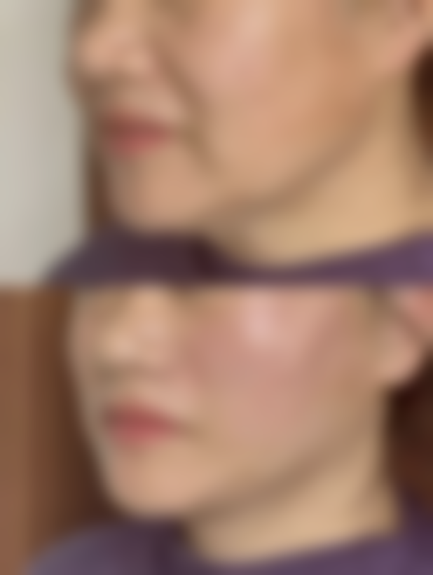 脸部除皱针多久有成效