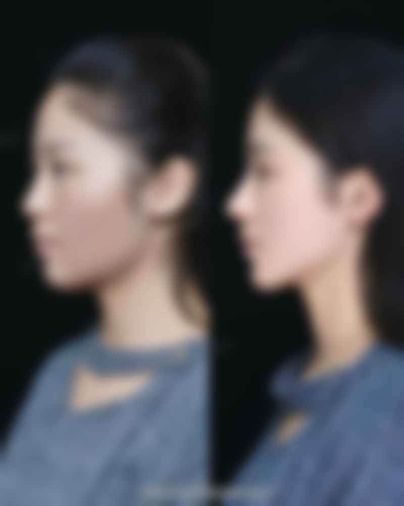 刚打瘦脸针的不同阶段表现