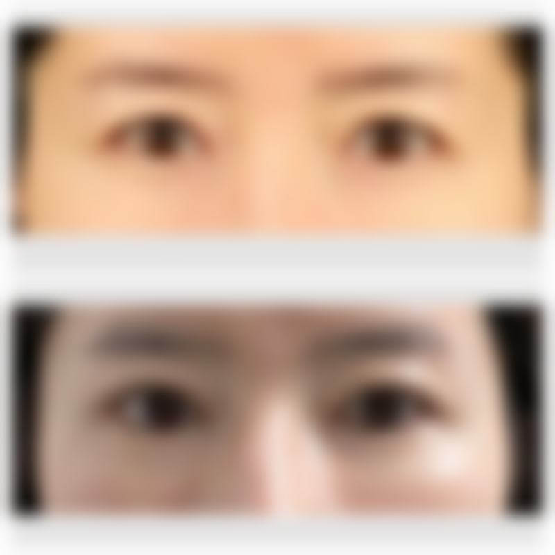 刚打了瘦脸针有什么反应