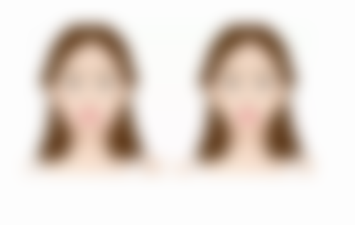 与自体脂肪填充面部、泪沟修复差异