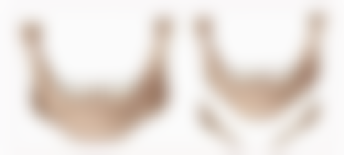 脸肥胖打瘦脸针有用吗