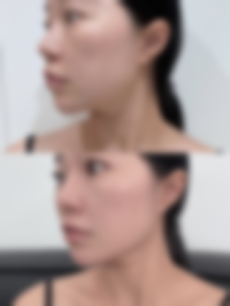 嘴角肉下垂如何改善图片和视频