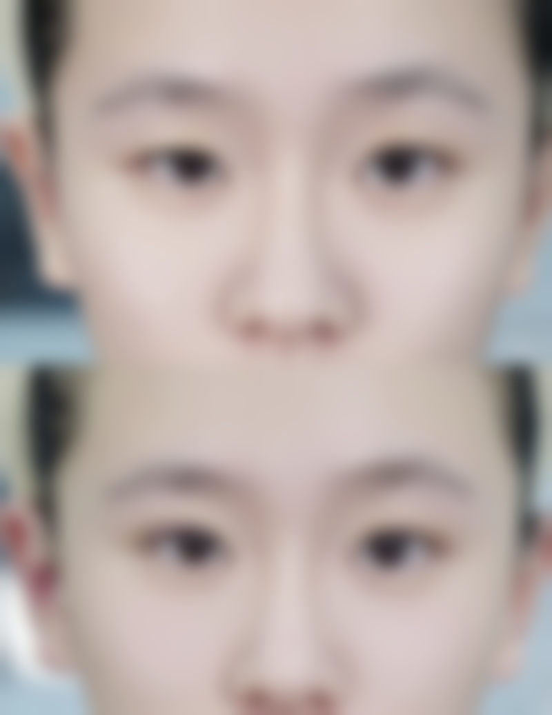 瘦脸针打一次维持多久