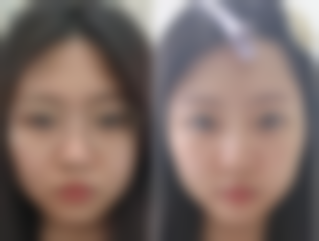 自体脂肪丰臀修复期多长