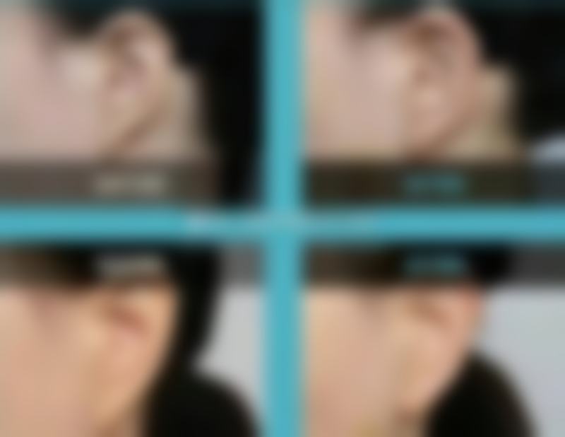 嘴唇比较厚怎么办？解析3种热门医美方法，让你轻松拥有自然精巧美唇，不再为厚唇困扰！ 