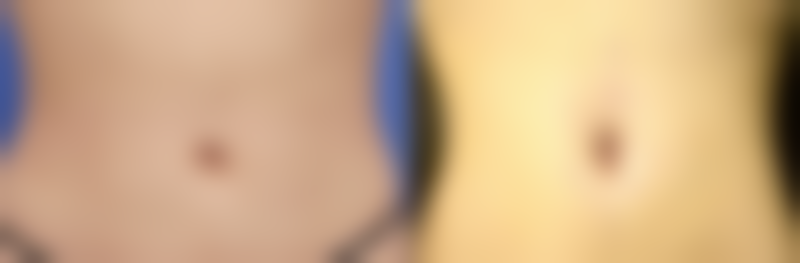 其他瘦咬肌的方法