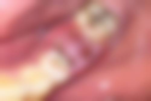 选择瘦脸针的注意事项