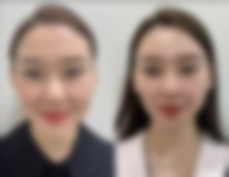 瘦脸针800一针合适吗？剖析价格与效果的平衡，揭秘800元一针瘦脸针的高性价比优势！ 