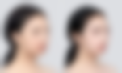 甲亢可以打瘦肩针嘛?