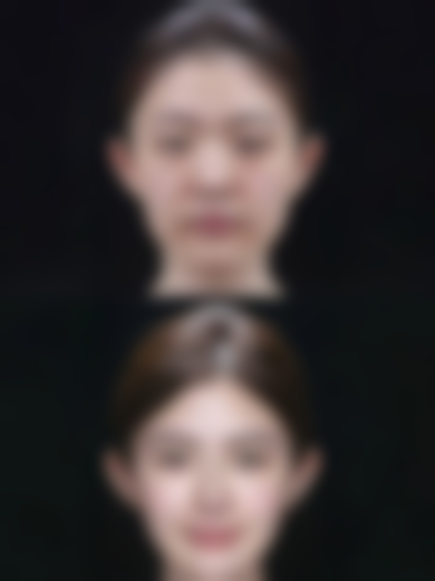 头发种植后多久能长出来？揭秘3个月初步生长、6 - 9个月显著效果、1年完全成型的惊人周期！ 