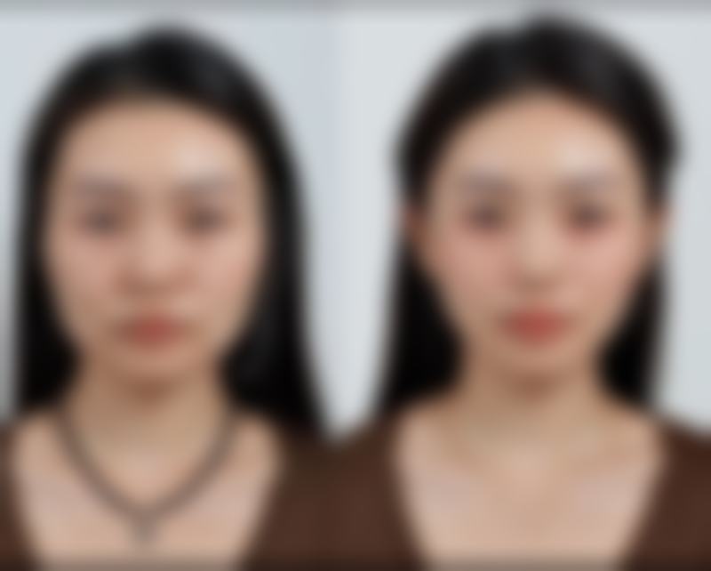 打一针瘦脸针成效会明显吗?