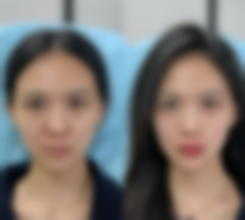 种植头发的其他可能风险