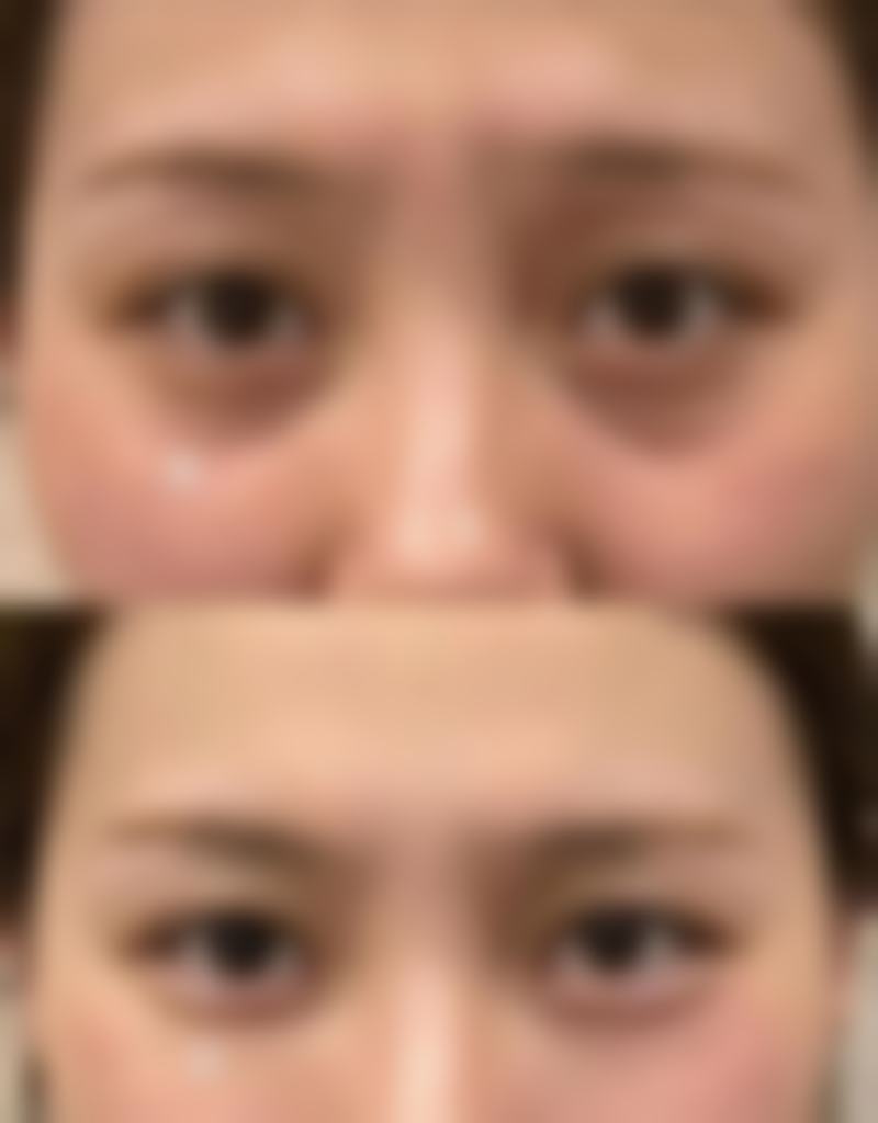 美白针含量成分是什么