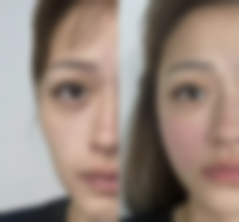 丰太阳穴的注意事项