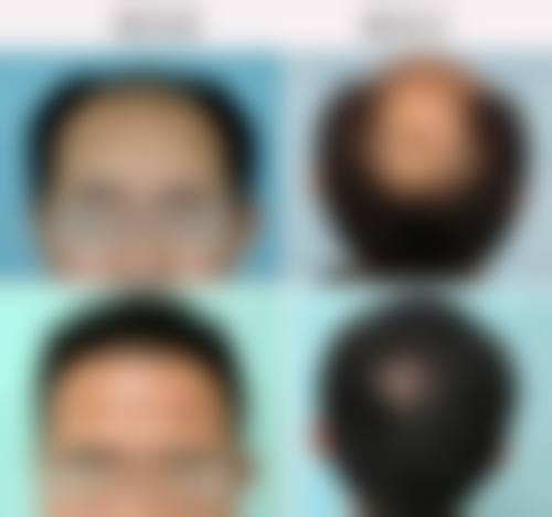 【北京科发源植发专科医院参考价格表：】