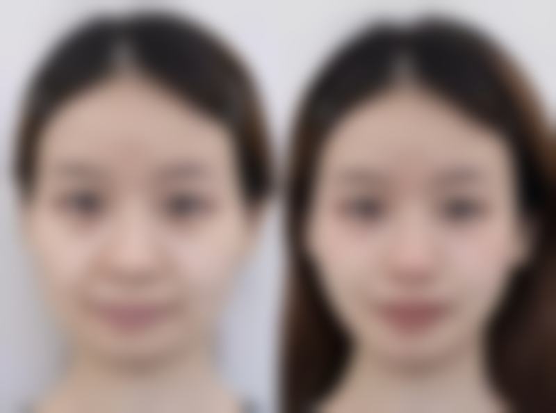 瘦脸针打三次就可以恒久定型了吗