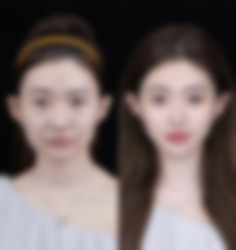 打瘦脸针得注意事项