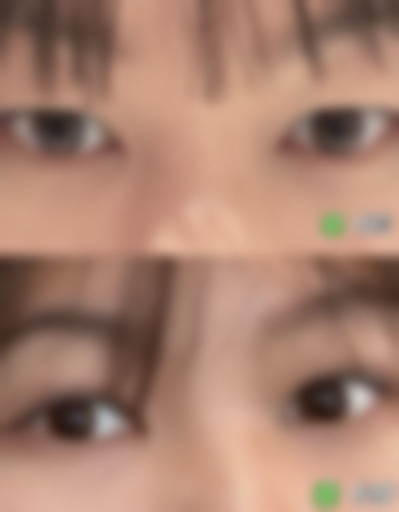 如生天使针：长效全脸填充除皱