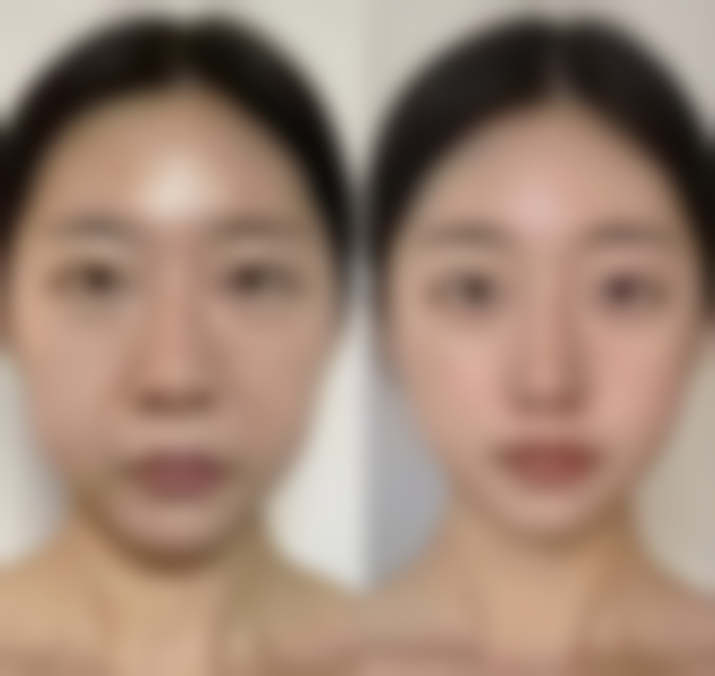 上唇厚可以做手术做薄吗？答案是肯定的！专业医美手术助你轻松拥有精致薄唇，重拾自信魅力！ 