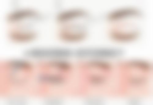 种植的头发脱落期