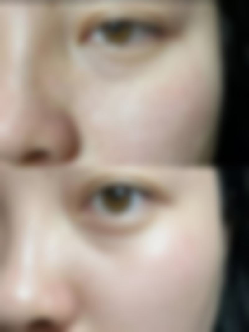 毛发种植的成效